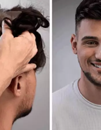 Best Hair Patch Replacement, Hair Wigs Services in Viman Nagar Pune