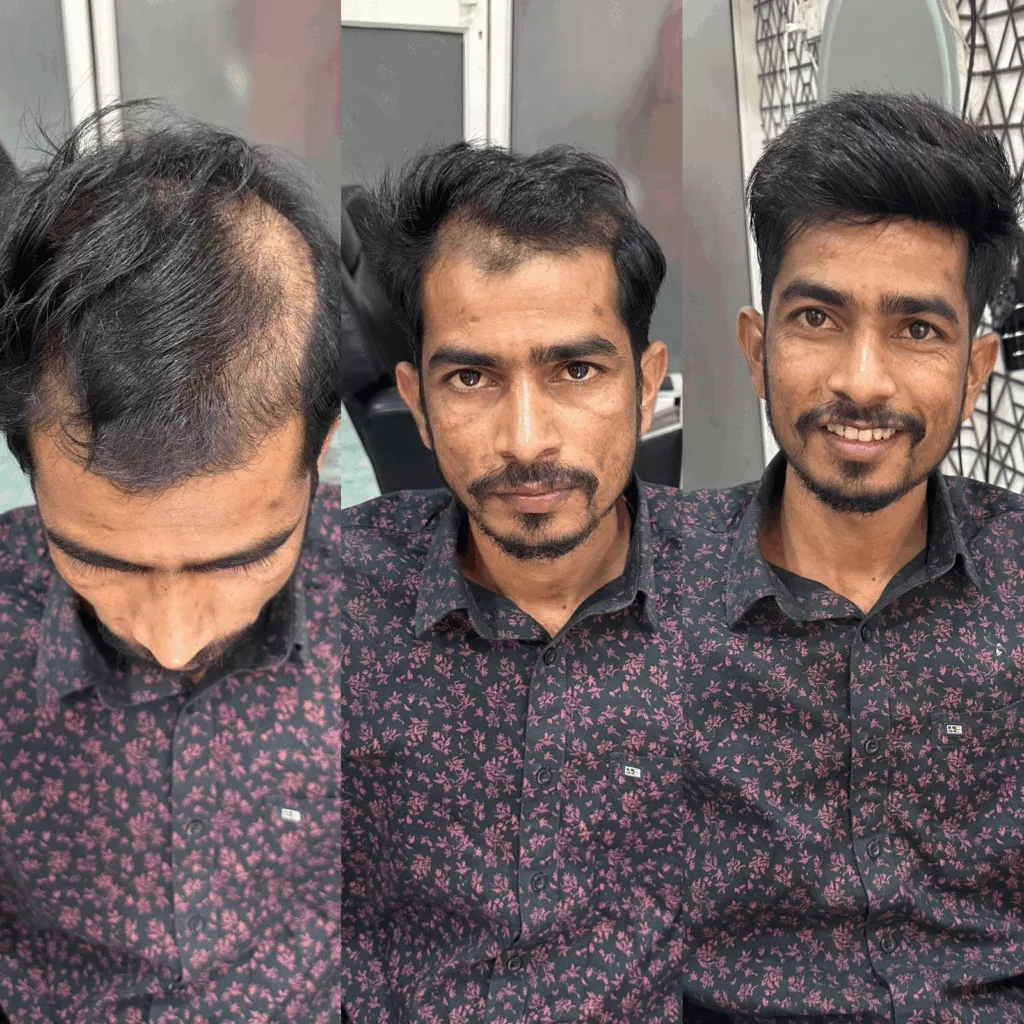 best hair patch services in Viman Nagar Pune