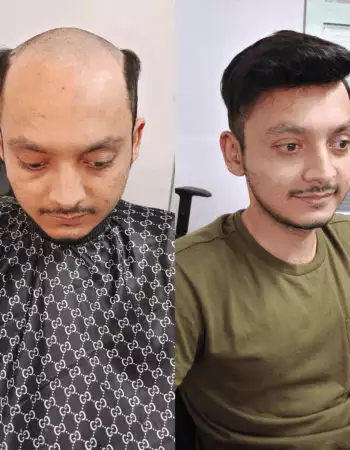 Best Hair Patch Replacement, Hair Wigs Services in Viman Nagar Pune