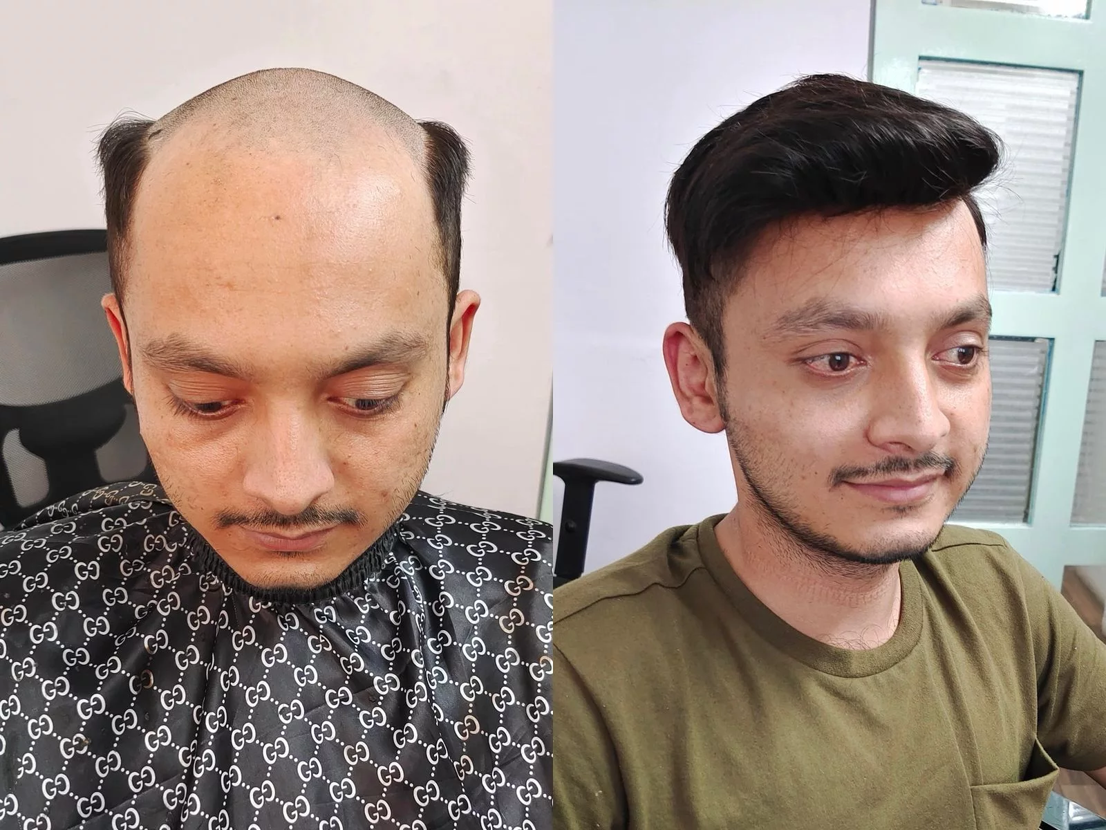 permanent hair patch cost in Pune