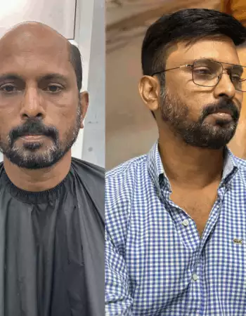 Best Hair Patch Replacement, Hair Wigs Services in Viman Nagar Pune