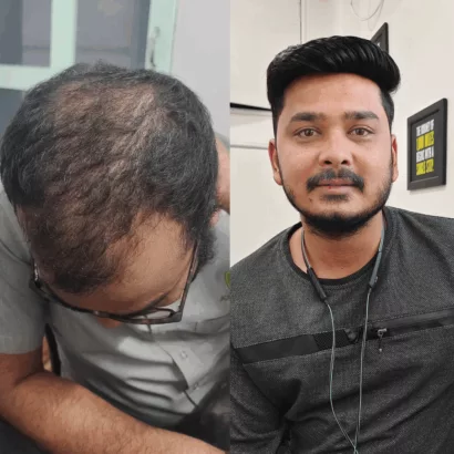 customized hair wig in Pune