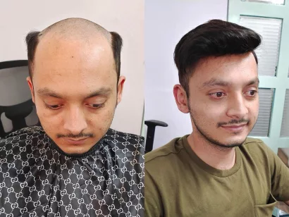 permanent hair patch cost in Pune