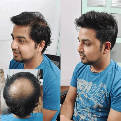 Men’s Hair Fixing & Bonding